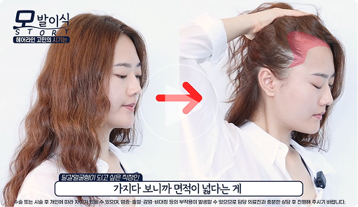 모모 수술상담 썸네일1