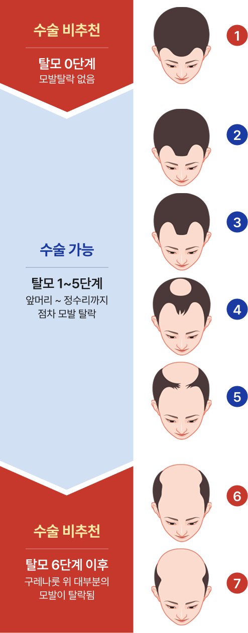 모발이식 골든 타임