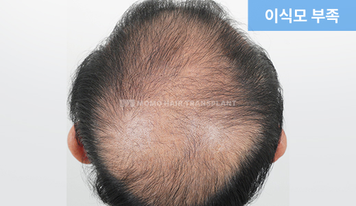 이식모 부족