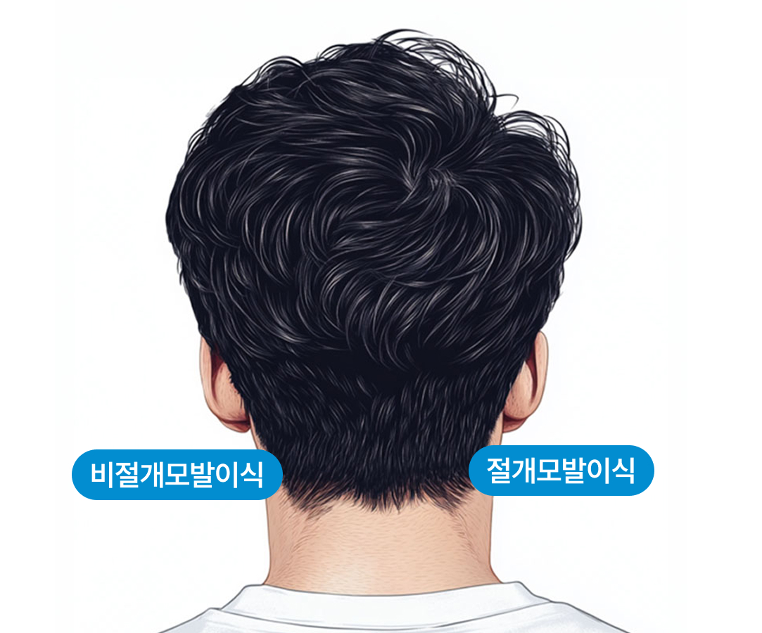 풍성한 혼용 모발이식 절개+비절개