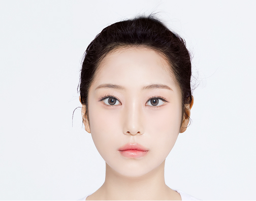 남성 절개 모발이식 after