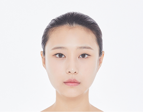 남성 절개 모발이식 before