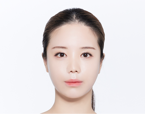 남성 절개 모발이식 before