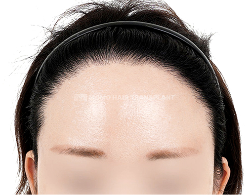 여성 정수리 모발이식 after
