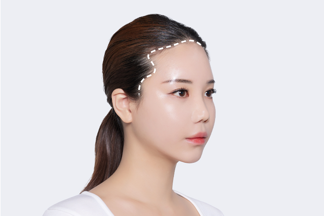 모모 흉터커버 모발이식이 특별한 이유