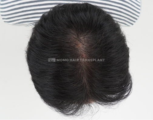 女性头顶植发 after