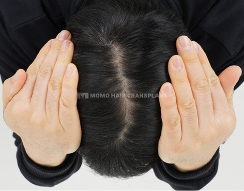 女性额头提升疤痕覆盖非切开 after