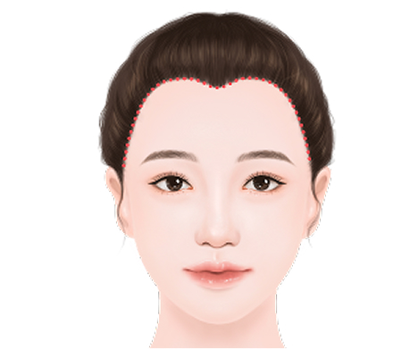 M型额头