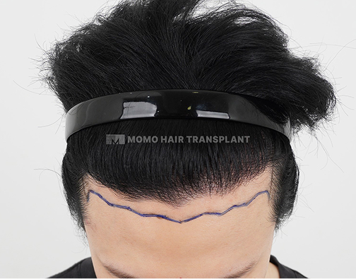 Forehead lift scar cover non-incisional hair transplant before