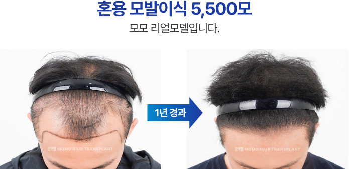 혼용 모발이식 5500모