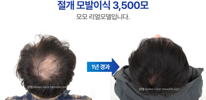 절개 모발이식 3500모