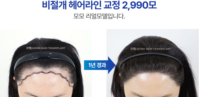비절개 헤어라인 교정 2990모