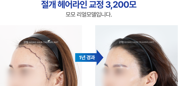 절개 헤어라인 교정 3200모
