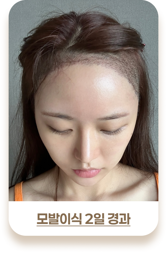 여성 모발이식 비포 & 애프터