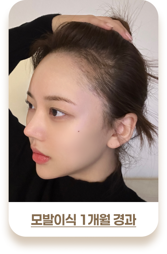 여성 모발이식 비포& 애프터