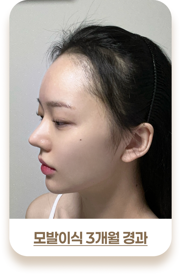 여성 모발이식 비포& 애프터