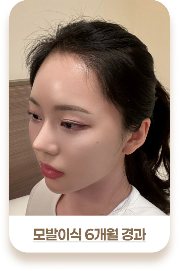 여성 모발이식 비포& 애프터