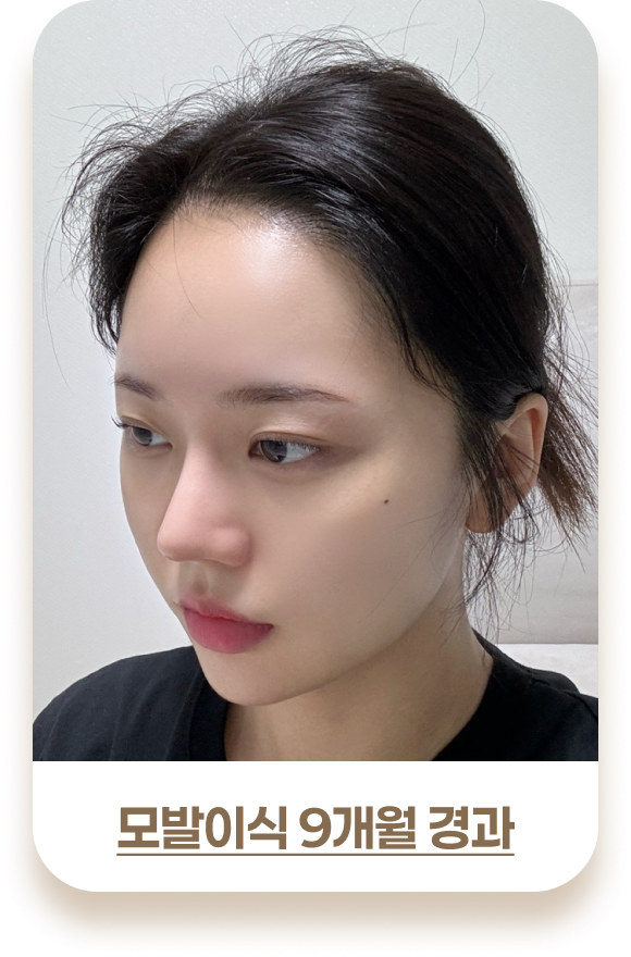 여성 모발이식 비포& 애프터