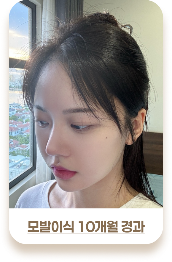 여성 모발이식 비포& 애프터