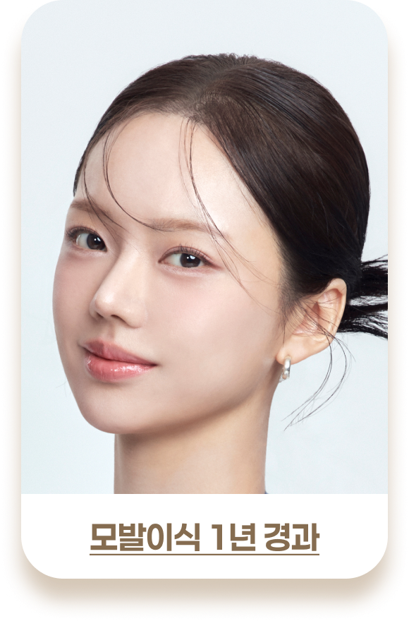 여성 모발이식 비포& 애프터