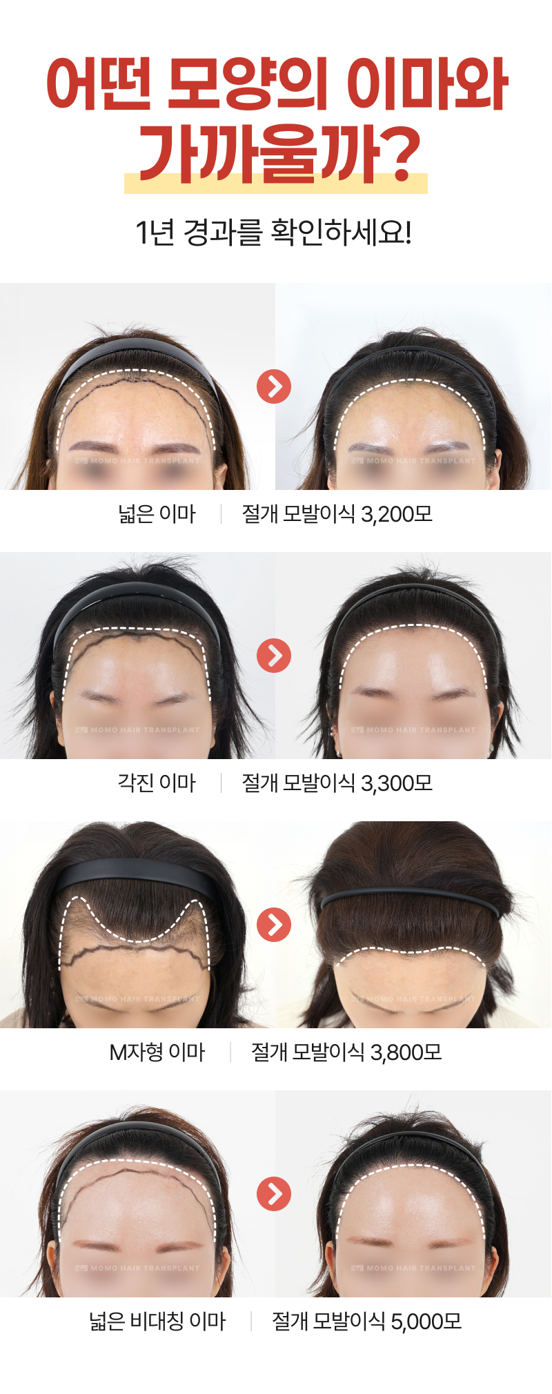 1년 경과 전/후 사진