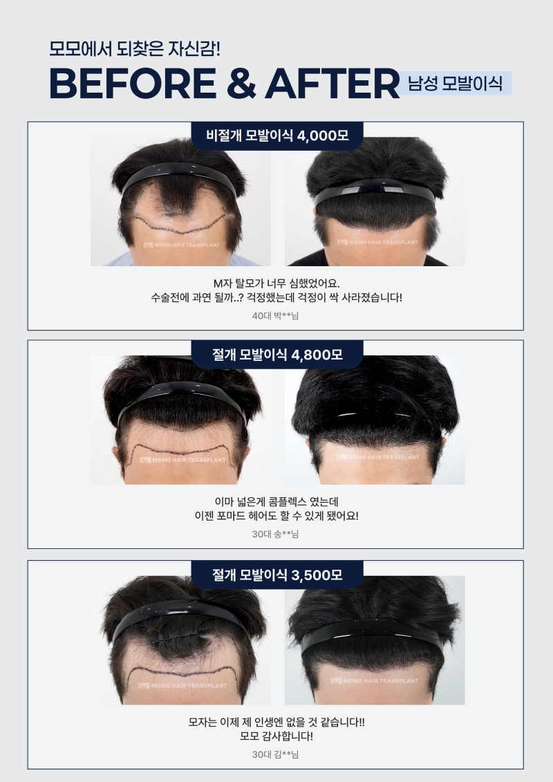 모모에서 되찾은 자신감! 남성 모발이식 Before & After