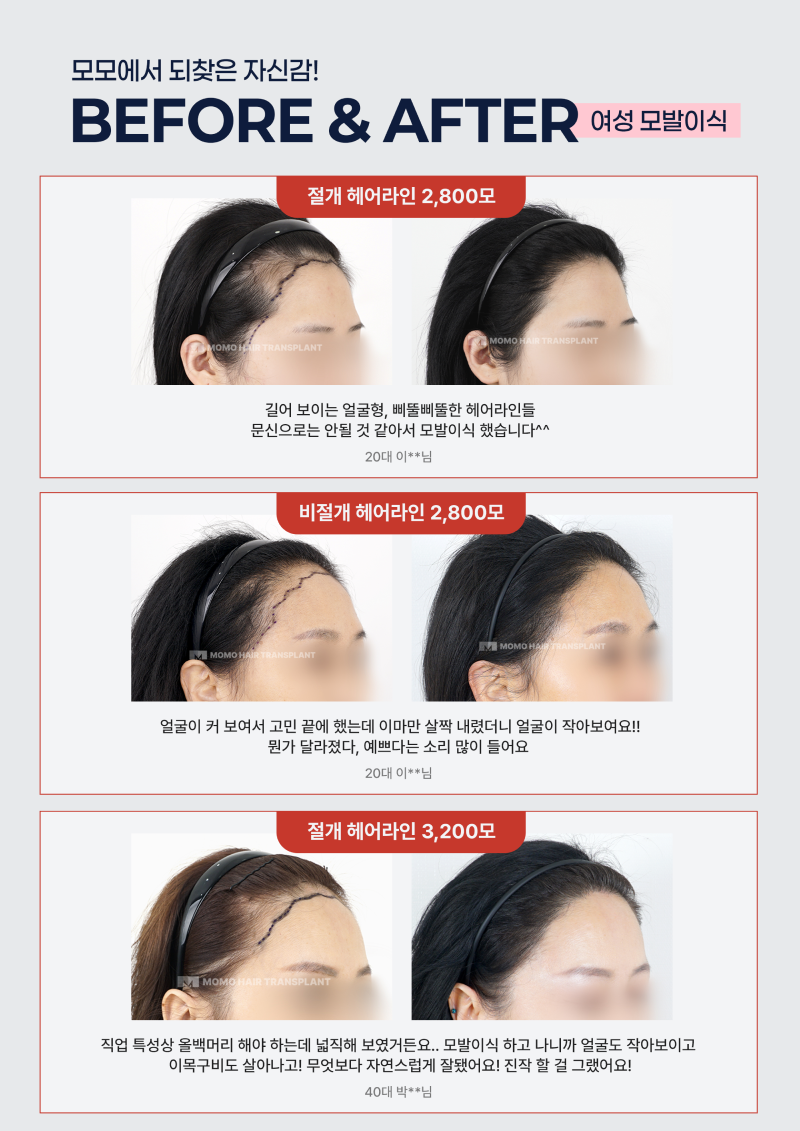 모모에서 되찾은 자신감! 여성 모발이식 Before & After