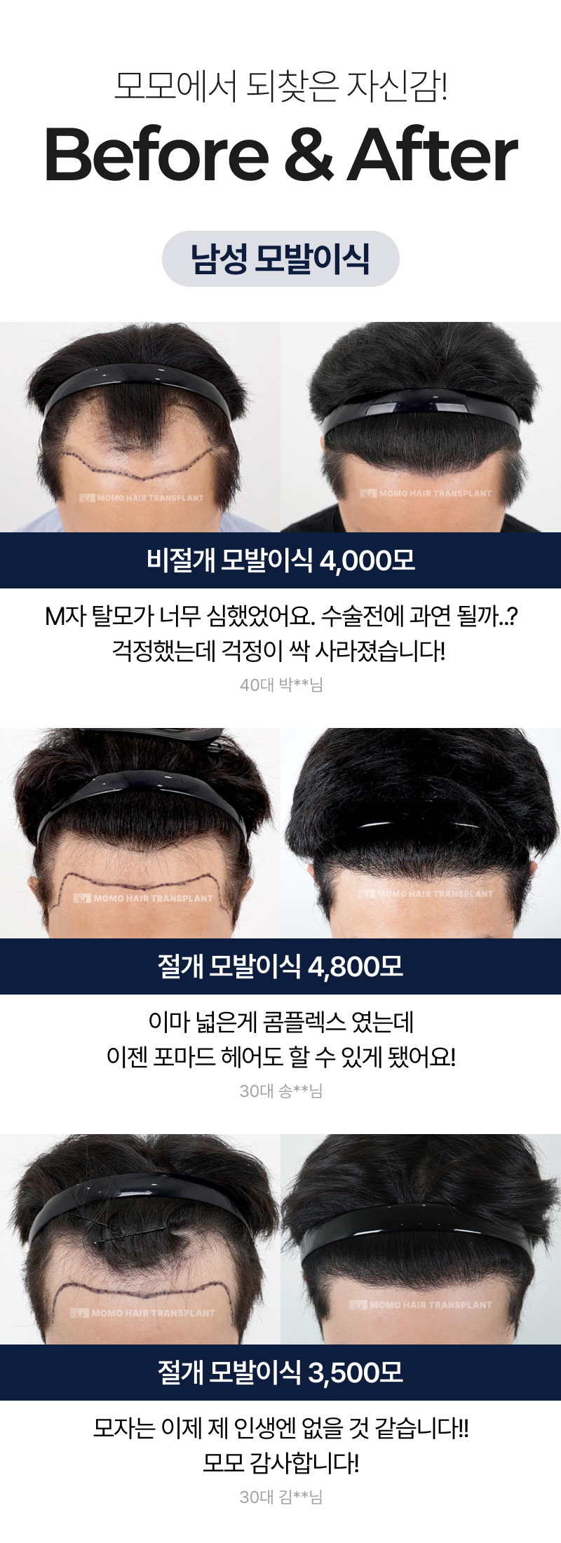 남성 모발이식 비포 & 애프터
