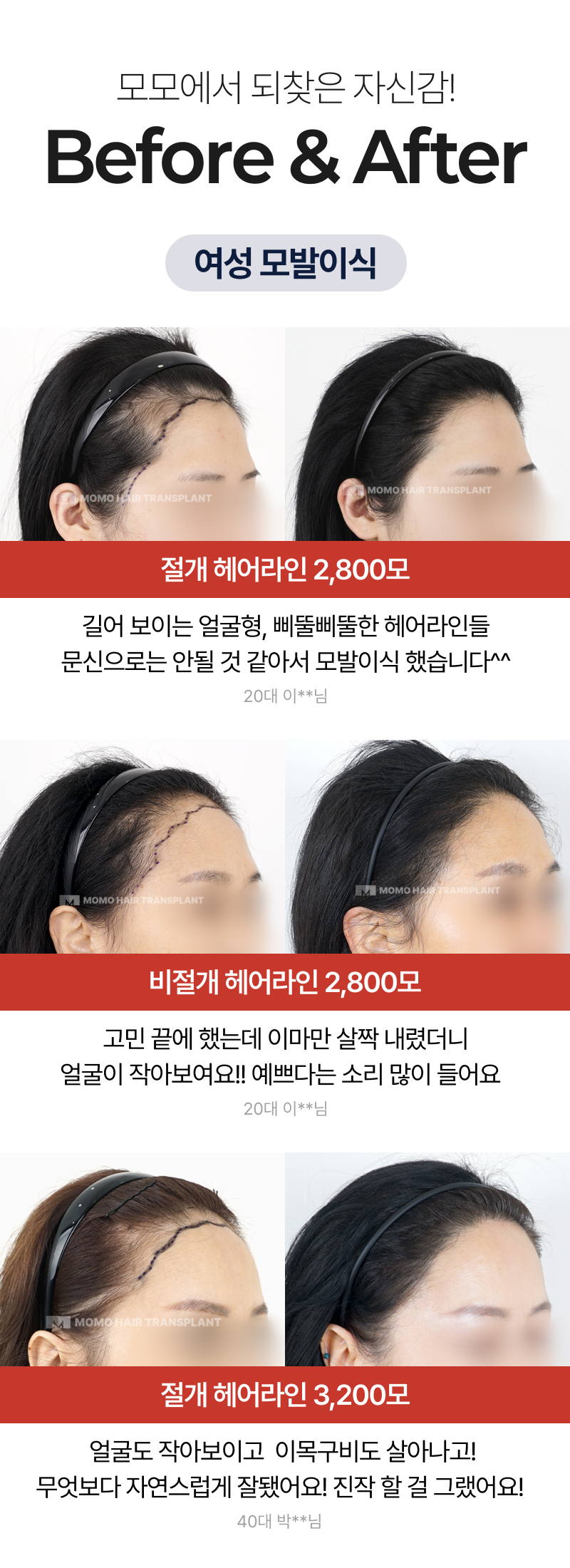 여성 모발이식 비포& 애프터
