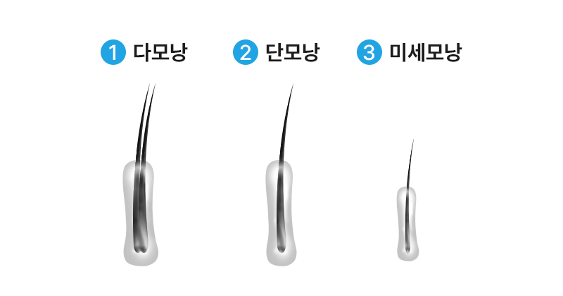 다모낭 단모낭 미세모낭