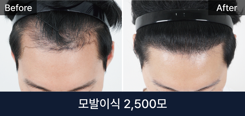 남성 모발이식 2500모