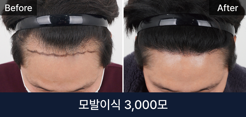남성 모발이식 3000모