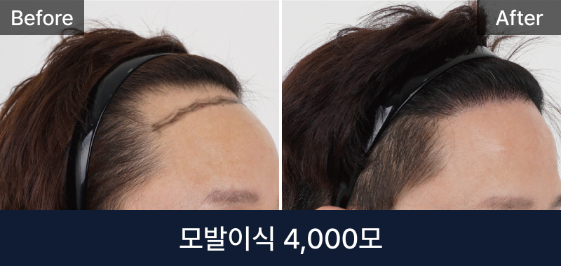 남성 모발이식 4000모