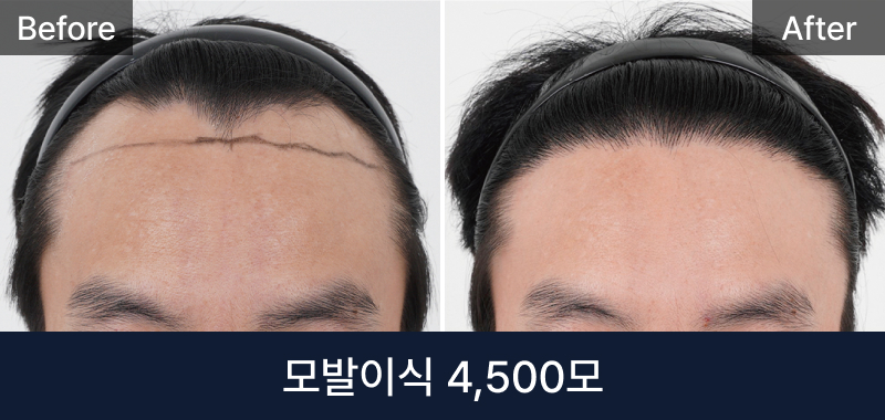 남성 모발이식 4500모