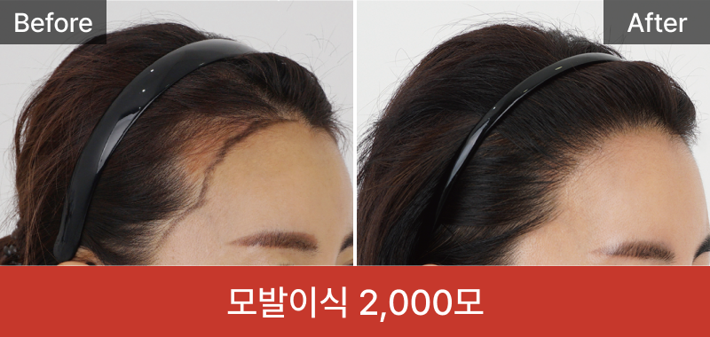 여성 모발이식 2000모