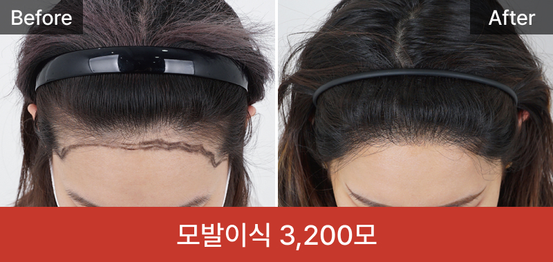 여성 모발이식 3200모
