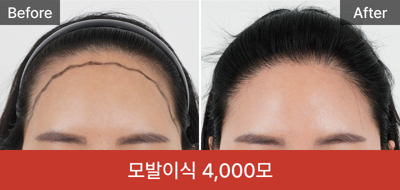 여성 모발이식 4000모