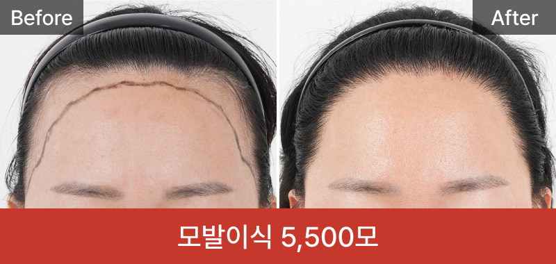 여성 모발이식 5500모