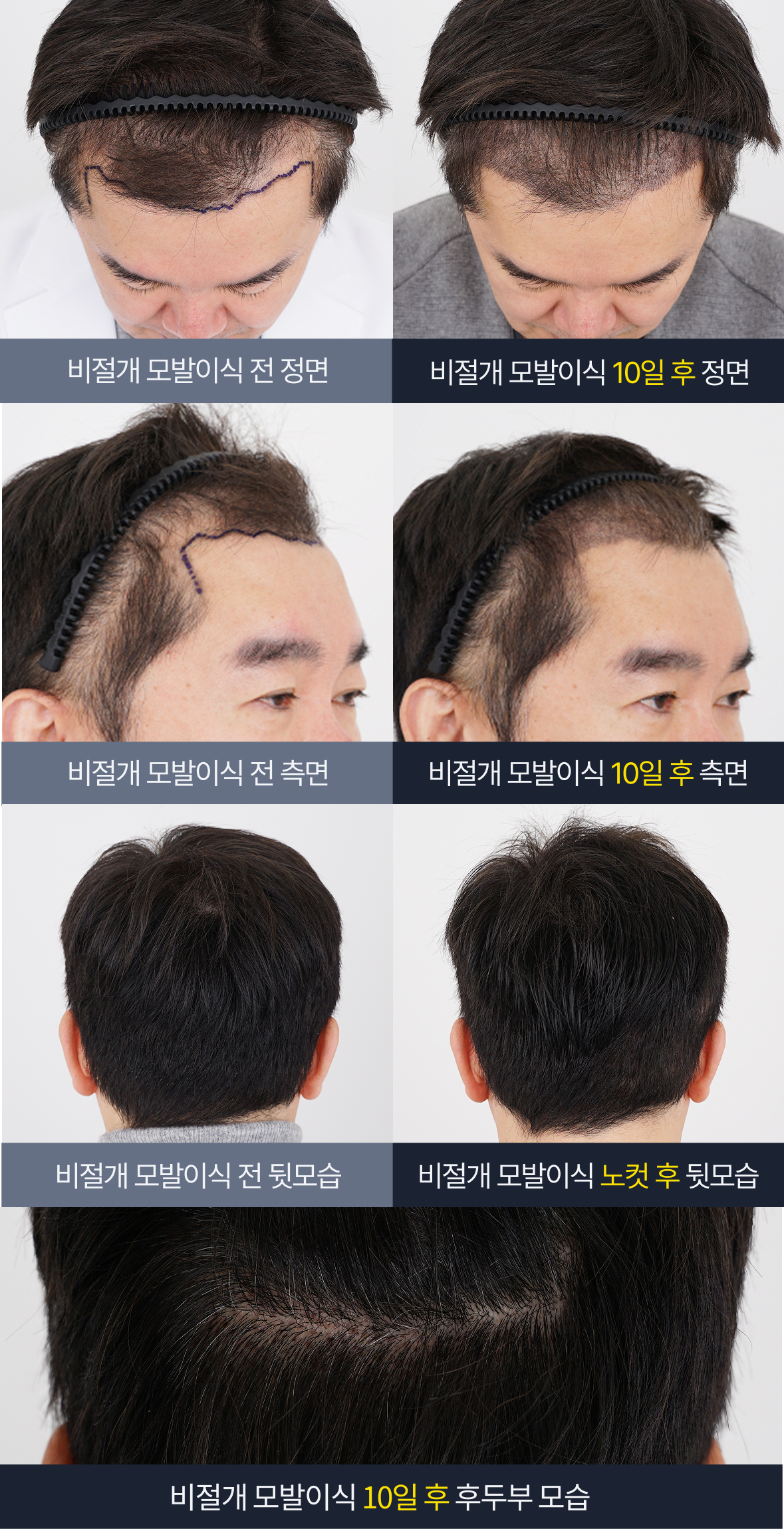 김승준 대표원장 모발이식 스토리