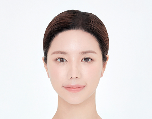 남성 절개 모발이식 after