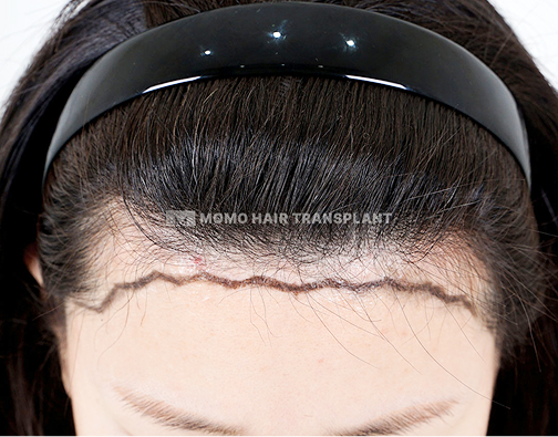 여성 정수리 모발이식 before