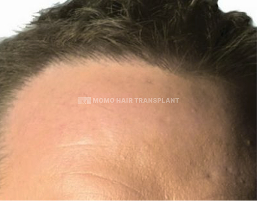 아타스iX 모발이식 after