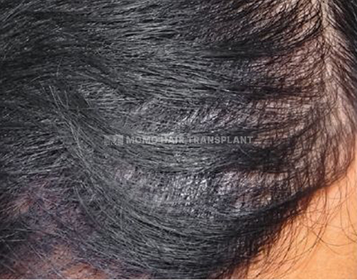 아타스iX 모발이식 after