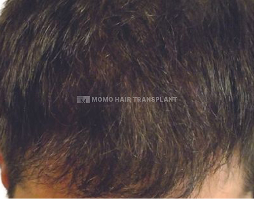 아타스iX 모발이식 after
