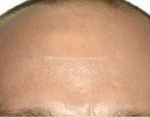 아타스iX 모발이식 before