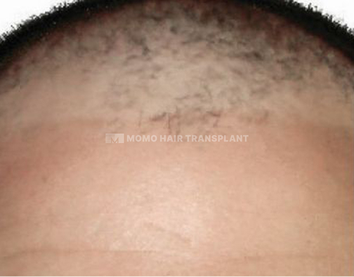 아타스iX 모발이식 before