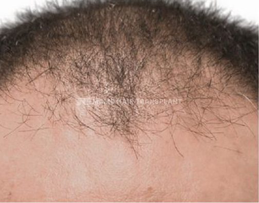 아타스iX 모발이식 before