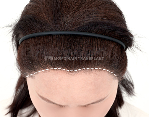 M자형 이마 절개 모발이식 after